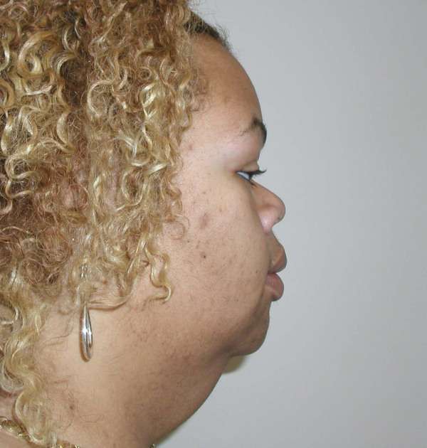 Face lift patient 2 before surgery, second gallery view